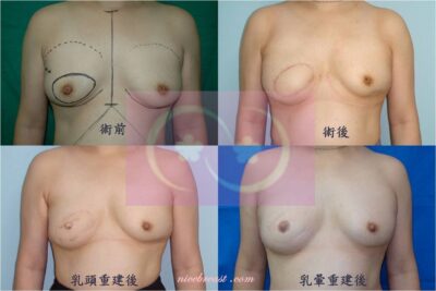 立即性乳房重建（DIEP Flap）-右乳