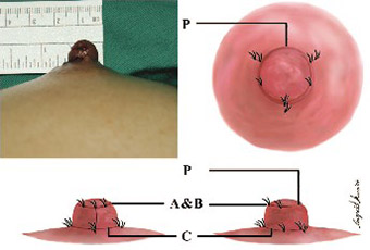 義乳放置位置： 乳腺下 （Subglandular）