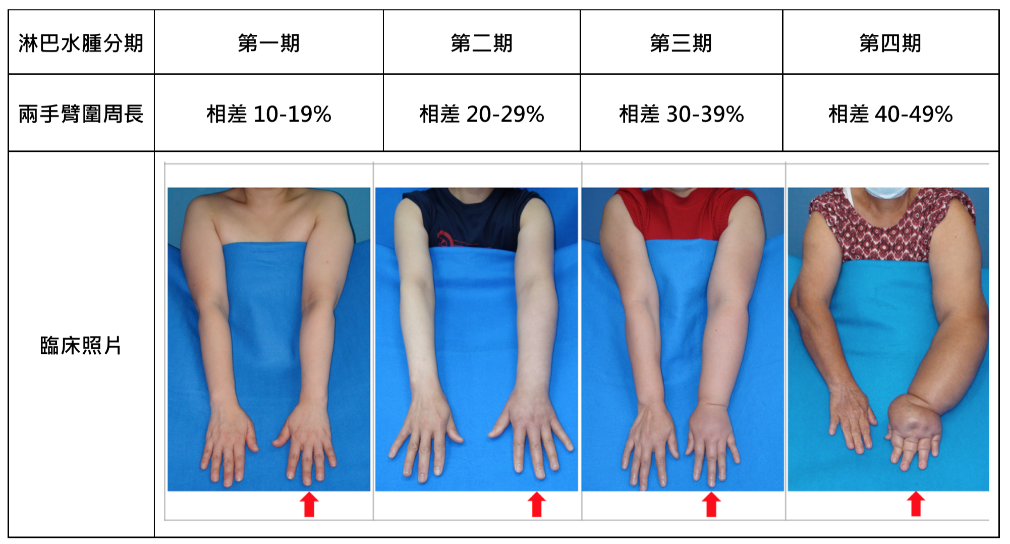 Principles and Practice of Lymphedema Surgery. Cheng MH, Chang DW, Patel KM (Editors). Elsevier Inc, Oxford, United Kingdom. ISBN: 978-0-323-29897-1. July 2015.